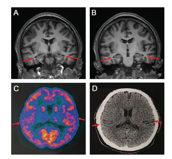 最小阿尔兹海默症患者19岁!研究参与者:一度不敢相信检查结果